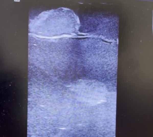 Breast Model (B-Ultrasound Guided Puncture Model) factory